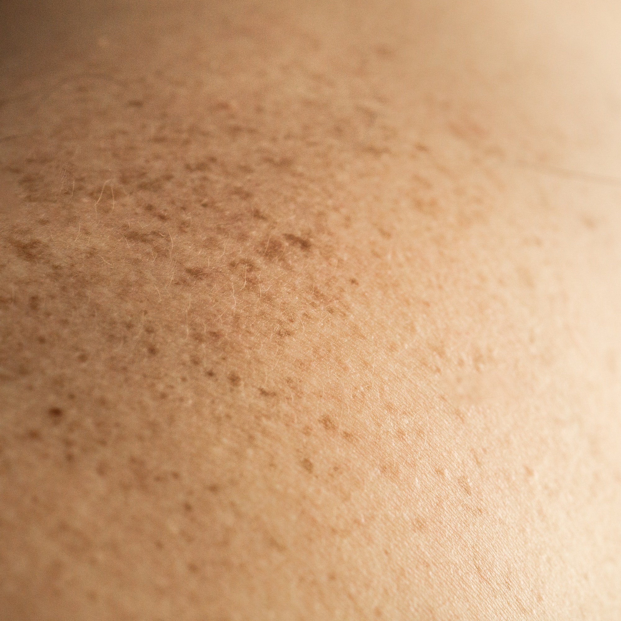 Skin on a man back with scattered moles